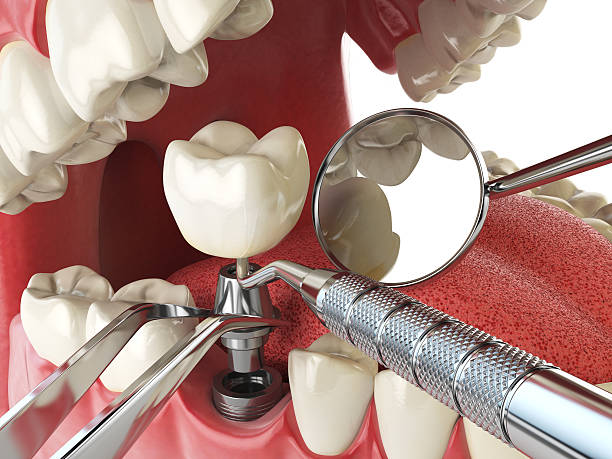 Best Emergency Dentist for Lost Fillings or Crowns in Zebulon, GA